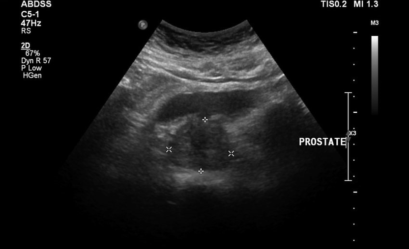 Ultrasound prostatitis before taking Urosaf