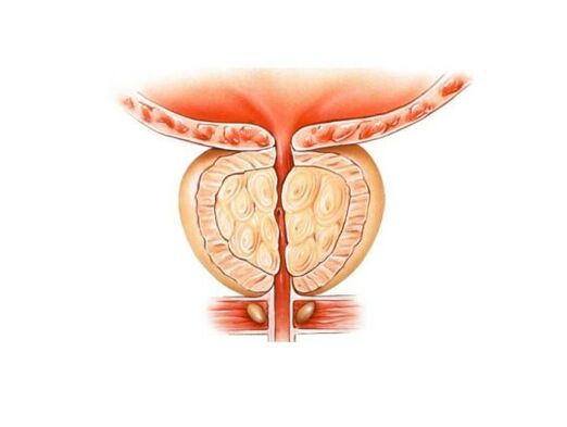 Increased prostate with prostatitis